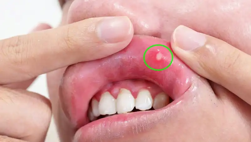 B Vitaminleri Eksikliği Belirtileri: Vücut Sağlığı İçin Tehlike